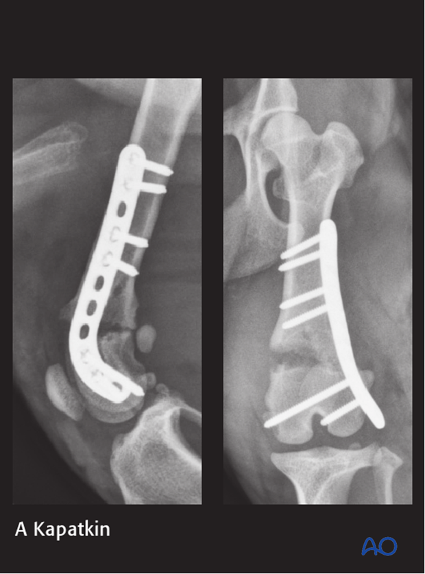 D33_P120_i260 plate fixation