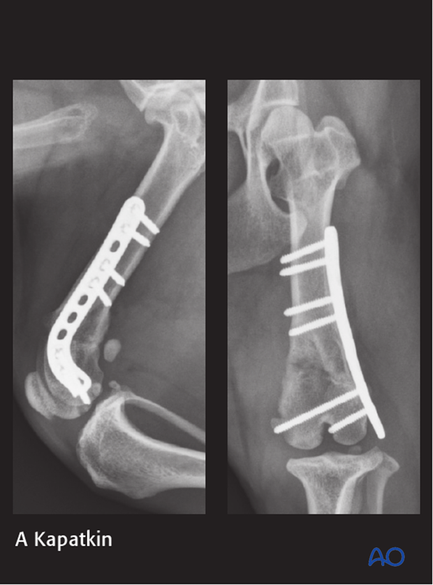 D33_P120_i280 plate fixation
