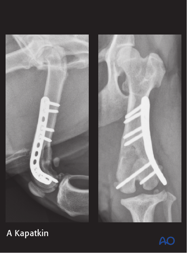 D33_P120_i300 plate fixation