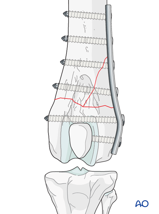 Distal femoral fracture in a dog repaired with a neutralization plate