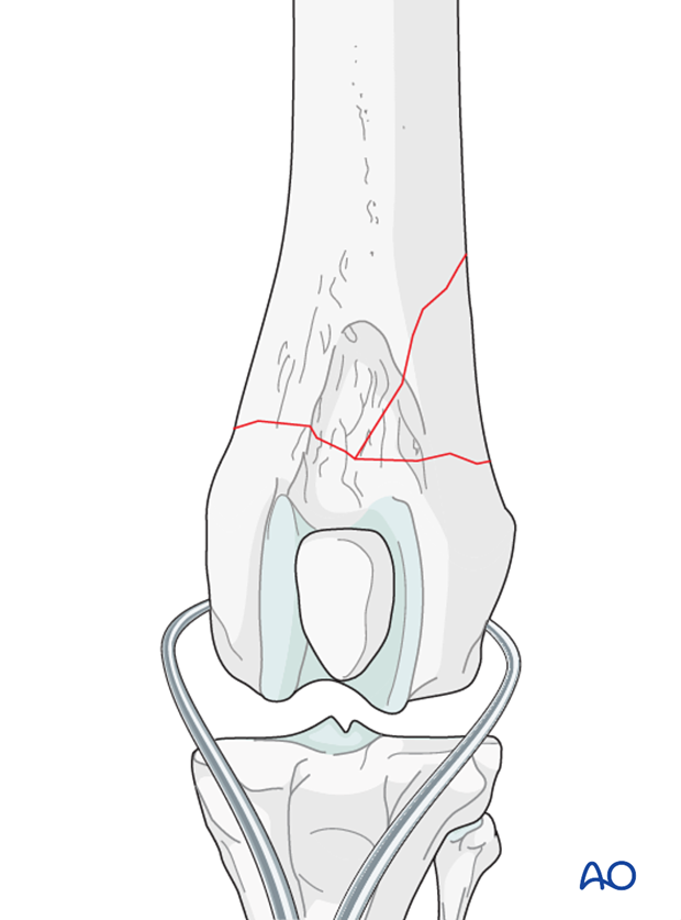 The fracture of the dog distal femur is reduced with pointed reduction forceps on each fragment