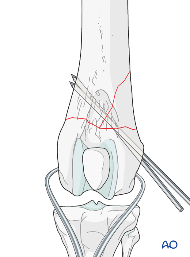 Preliminary stabilization can be achieved with reduction forceps or K-wires