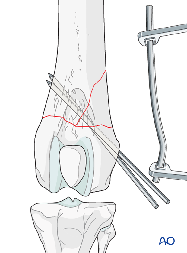 The plate is contoured to the lateral aspect of the distal femur