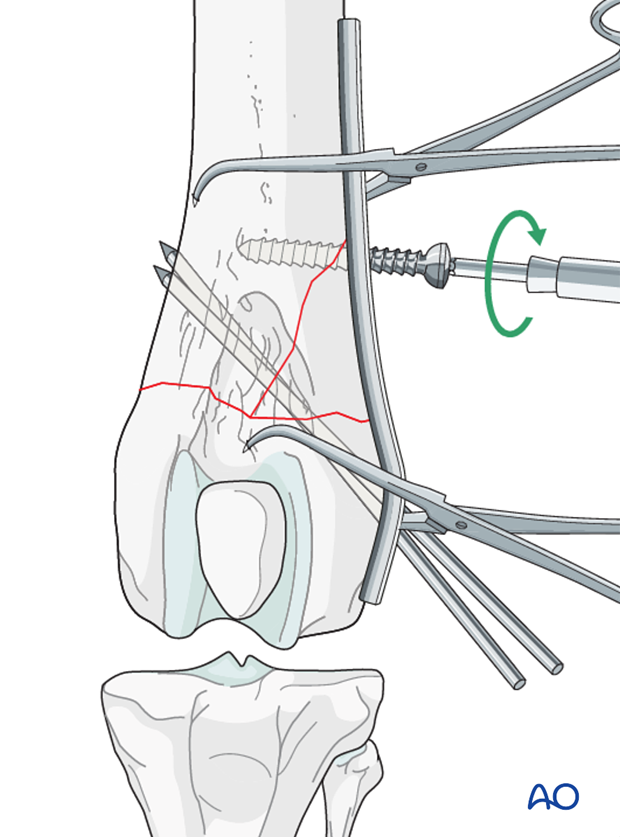 A screw is inserted in the proximal fragment in lag fashion