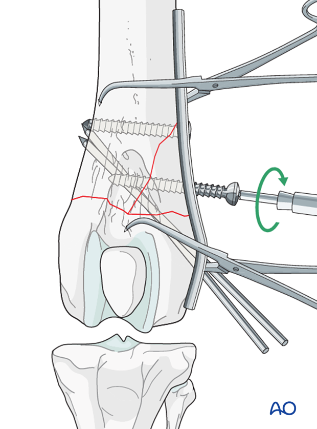 A second screw is inserted through the plate into the wedge fragment and the proximal segment in the neutral position