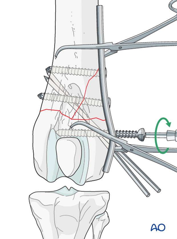 A screw is inserted in the distal fragment
