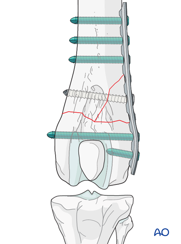 If a locking plate is used, only 2-3 locking bicortical screws are needed per main fragment