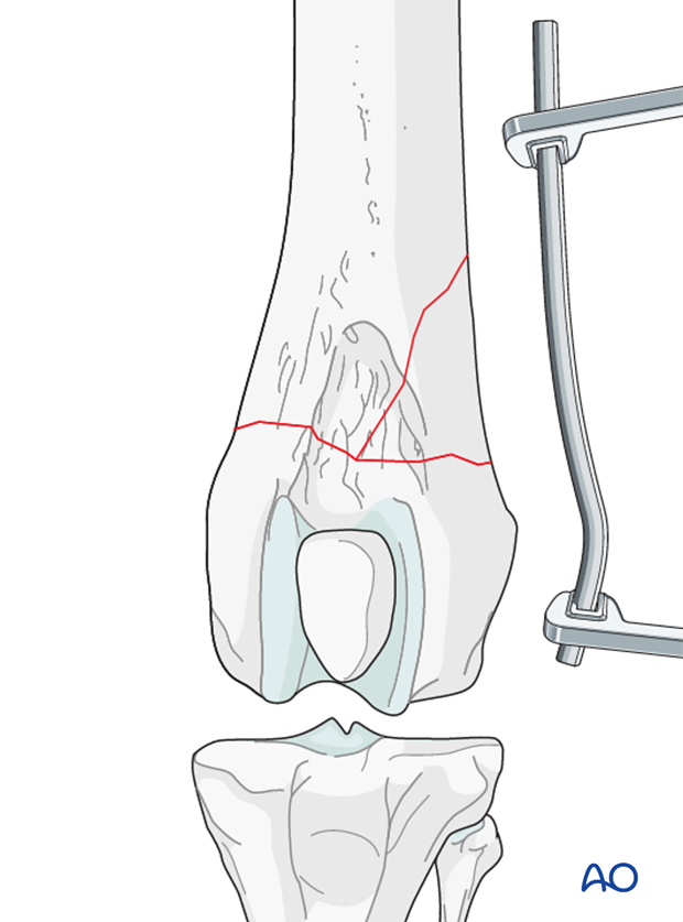 The plate is contoured to the lateral aspect of the distal femur