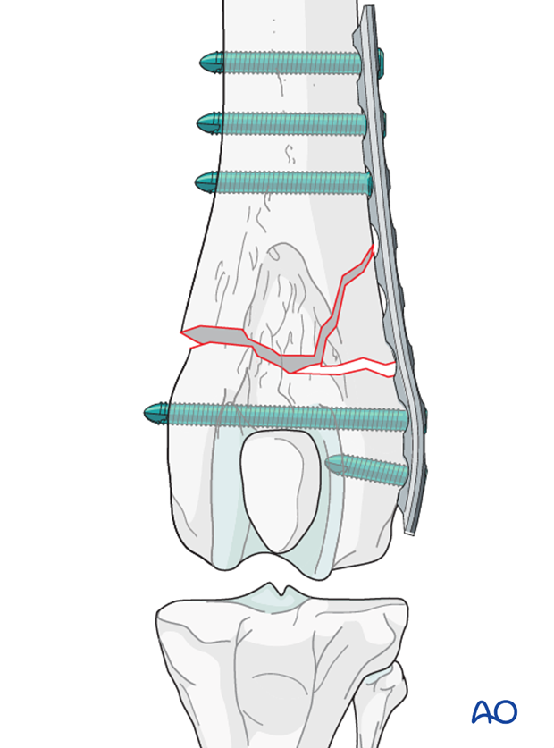 If a locking plate is used, only 2-3 locking bicortical screws are needed per main fragment