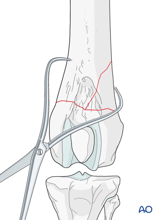 Preliminary stabilization can be achieved with reduction forceps