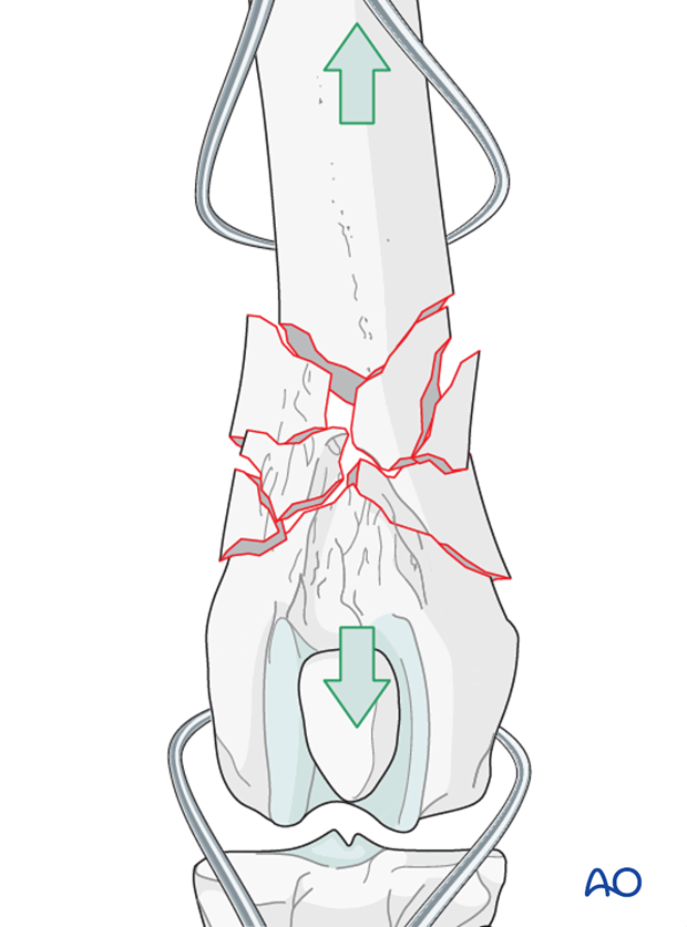 D33_P141_i060 Indirect reduction is achieved by distracting and aligning the major bone segments using bone clamps
