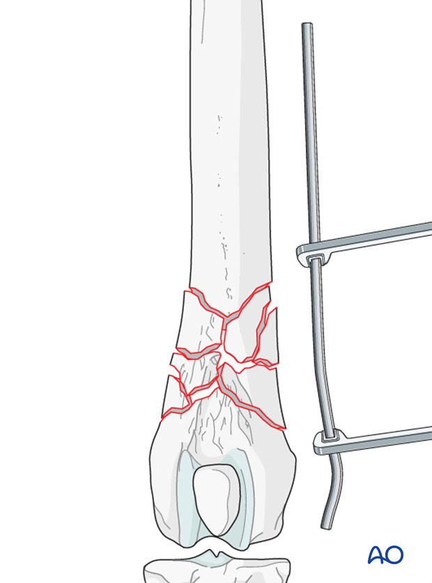D33_P141_i120 The plate is contoured to the lateral aspect of the distal femur