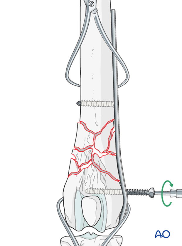 D33_P141_i140 Screws are placed in a near-near far-far pattern