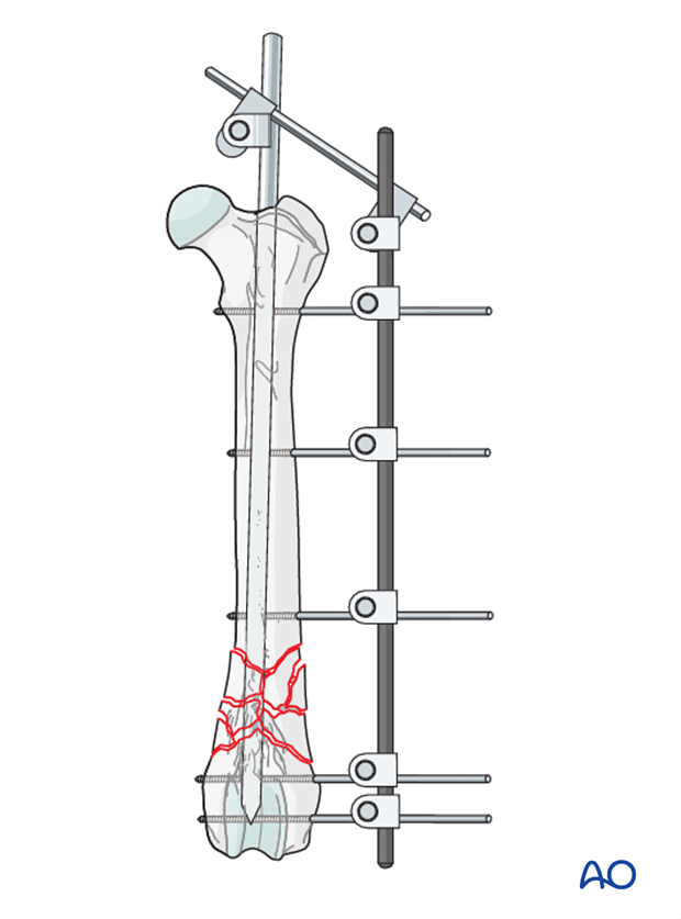 External skeletal fixator used to repair a distal femoral fracture in a dog