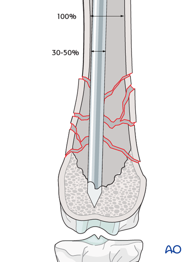 Dimensions of the intramedullary pin for external skeletal fixator used to repair a distal femoral fracture in a dog