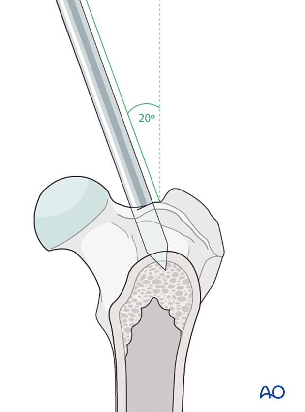 Intramedullary pin insertion for external skeletal fixator used to repair a distal femoral fracture in a dog