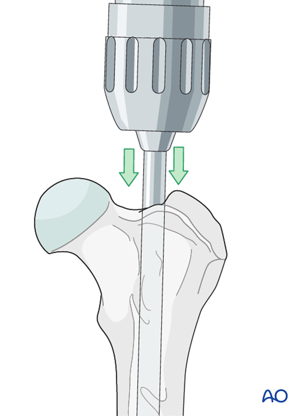 Intramedullary pin insertion for external skeletal fixator used to repair a distal femoral fracture in a dog