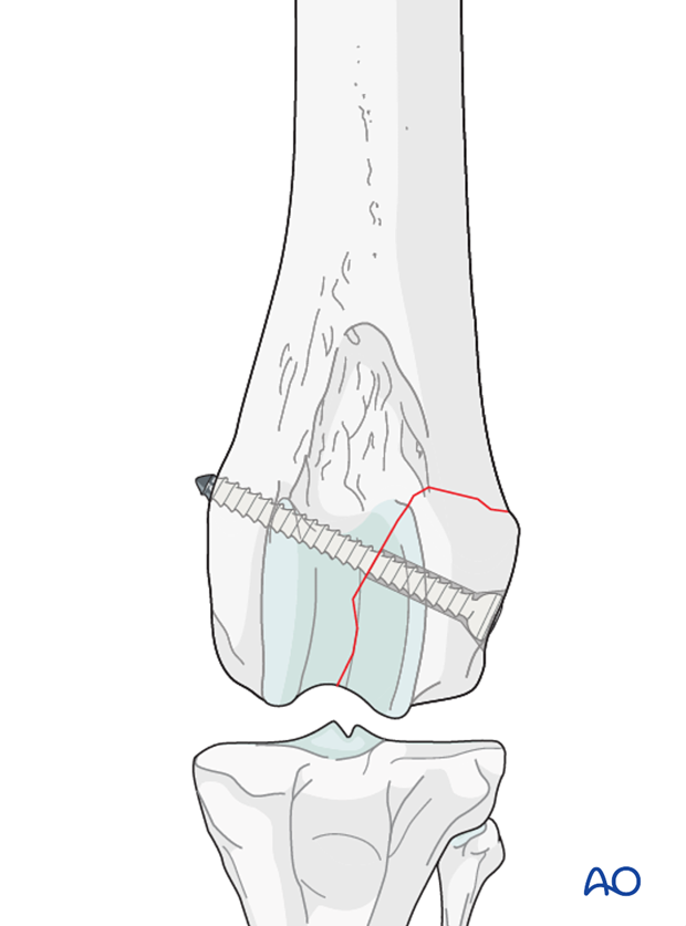 Lag screw fixation in a type B1 fracture in a distal femur of a dog