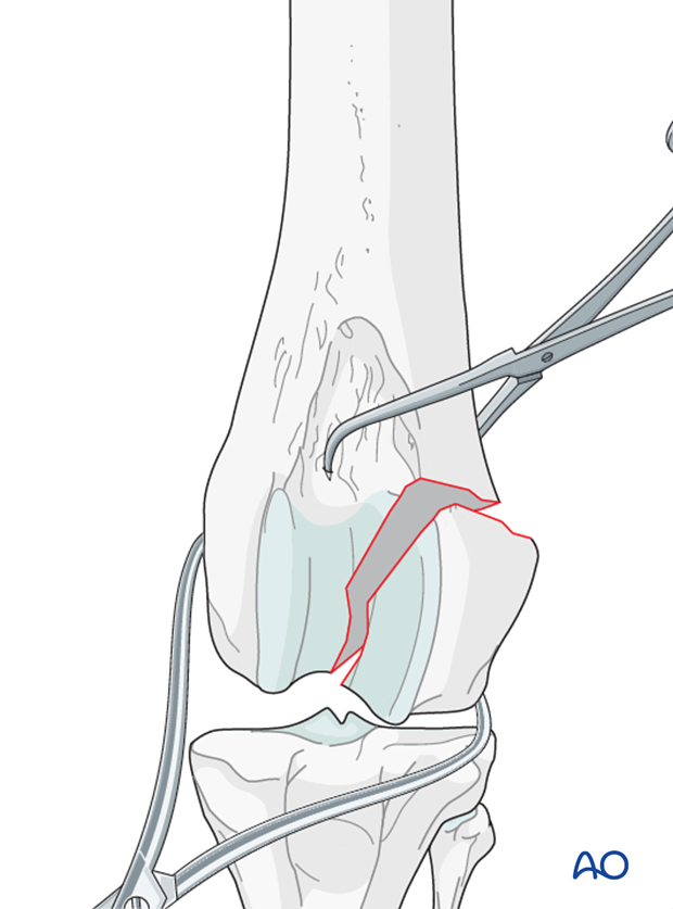 The fracture is reduced, and preliminary stabilization achieved with pointed reduction forceps