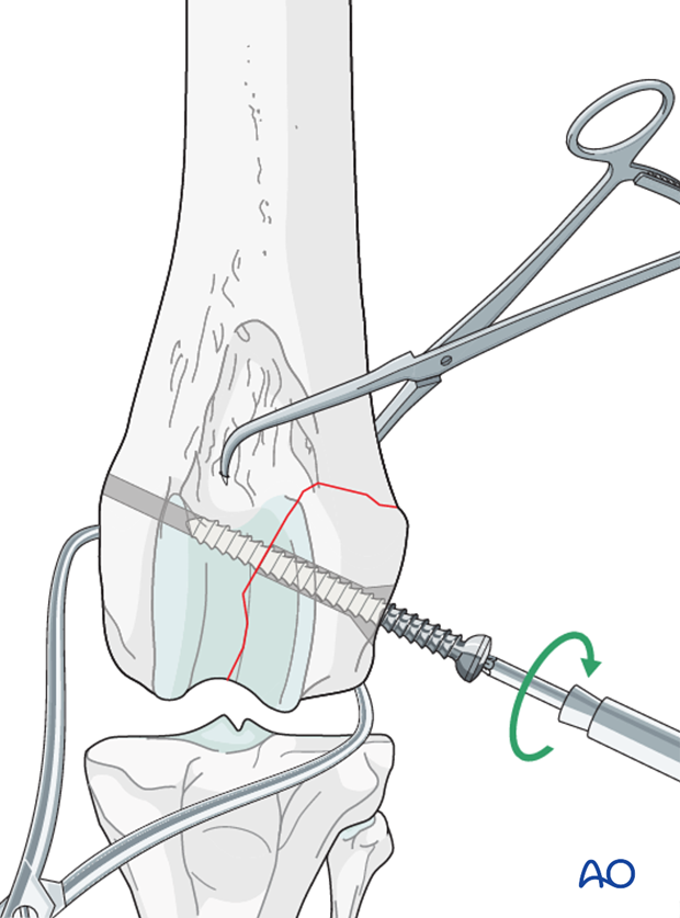 The lag screw is inserted perpendicular to the fracture plane