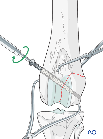 Screw fixation for Partial articular fracture, lateral condyle, sagittal