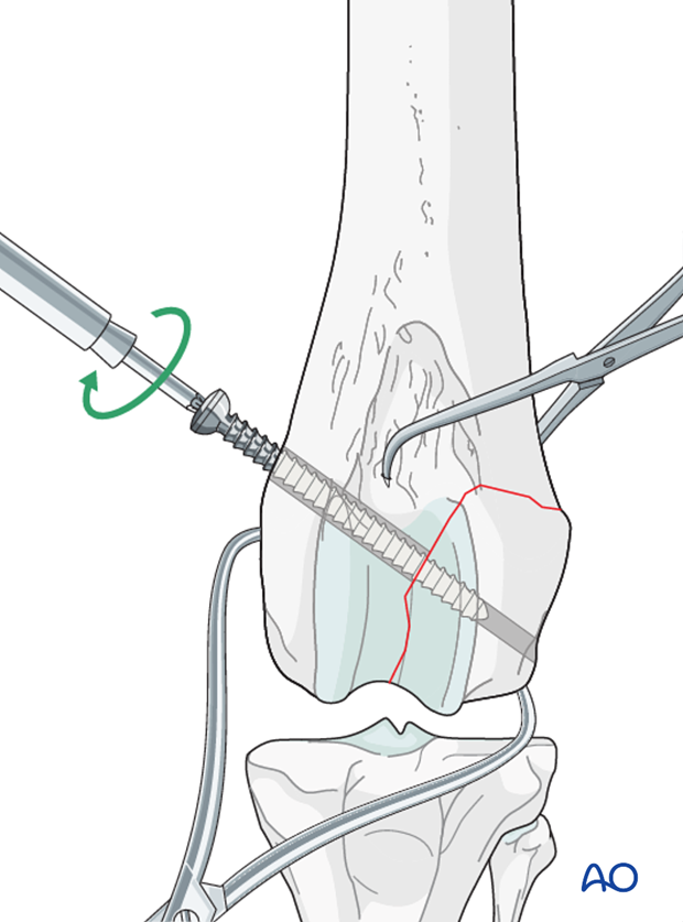 The lag screw is inserted perpendicular to the fracture plane