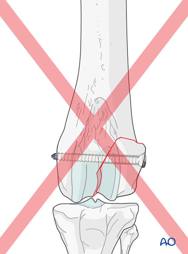 If the lag screw is not placed perpendicular to the fracture plane, this will result in loss of anatomic reduction of the articular surface