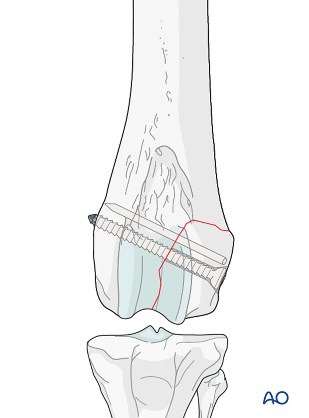 Additional stabilization can be achieved by a K-wire or an additional lag screw in larger fragments