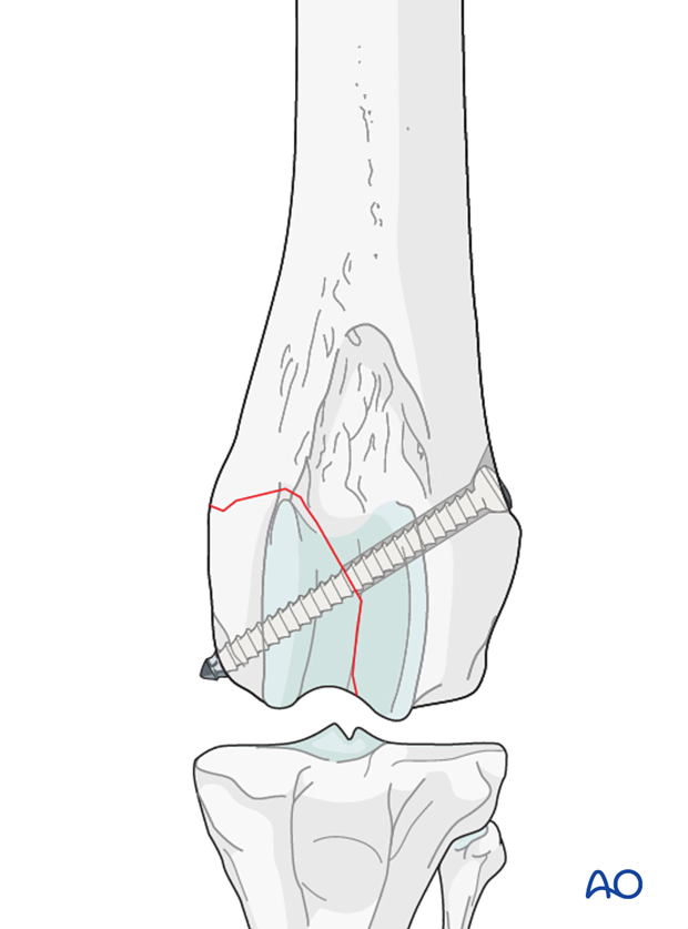 D33_P161_i020 Lag screw fixation in a type B2 fracture in a distal femur of a dog