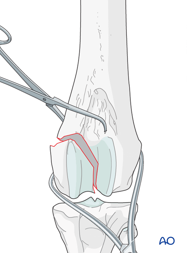 D33_P161_i040 The fracture is reduced, and preliminary stabilization achieved with pointed reduction forceps