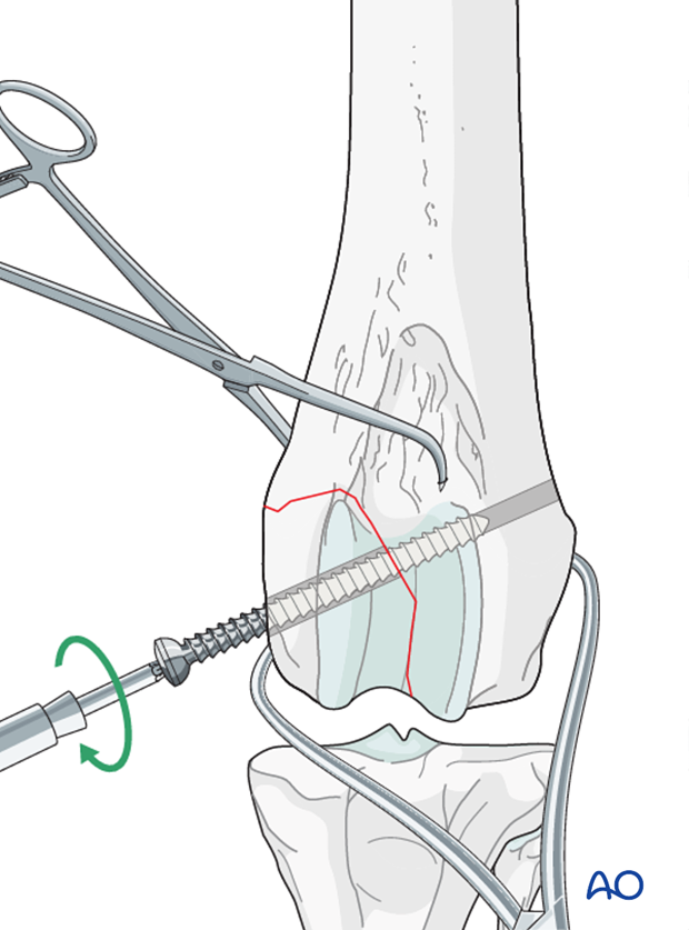 D33_P161_i080 The lag screw is inserted perpendicular to the fracture plane