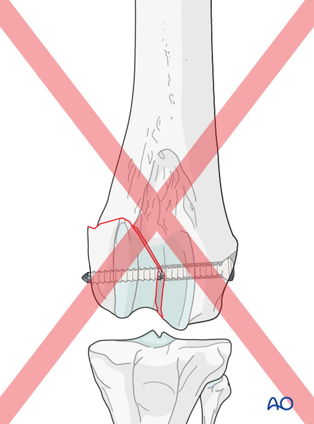 D33_P161_i100 If the lag screw is not placed perpendicular to the fracture plane, this will result in loss of anatomic reduction of the articular surface