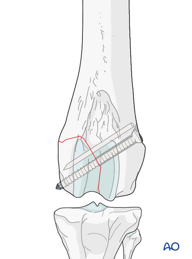 D33_P161_i120 Additional stabilization can be achieved by a K-wire or an additional lag screw in larger fragments