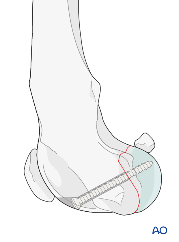 D33_P162_i020 Lag screw fixation in a type B3 fracture in a distal femur of a dog