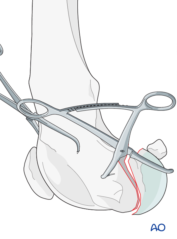 D33_P162_i040 The fracture is reduced, and preliminary stabilization achieved with pointed reduction forceps