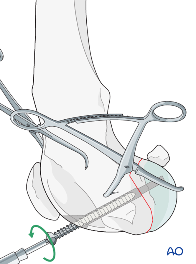Screw fixation for Partial articular fracture, frontal, unicondylar
