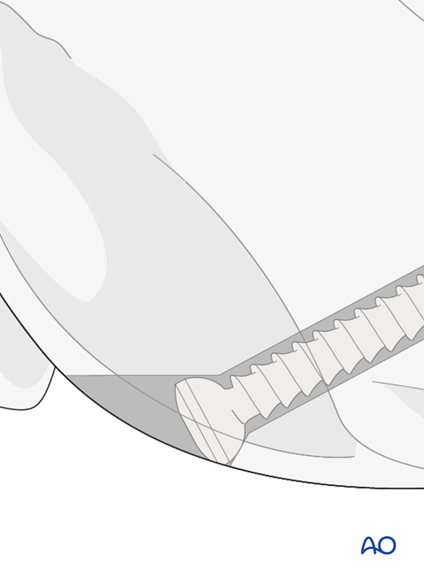 D33_P162_i080 The screw head must be countersunk under the articular surface to avoid interference with the patella