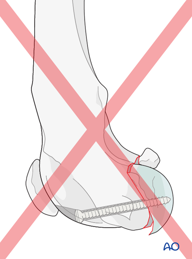 D33_P162_i100 If the lag screw is not placed perpendicular to the fracture plane, this will result in loss of anatomic reduction of the articular surface