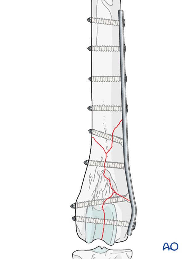 D33_P201_i040 Distal femoral fracture in a dog repaired with transcondylar lag screw and neutralization plate