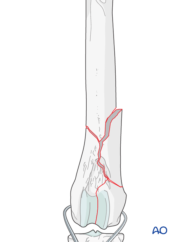 D33_P201_i060 The articular fracture of the condyles is reduced with pointed reduction forceps