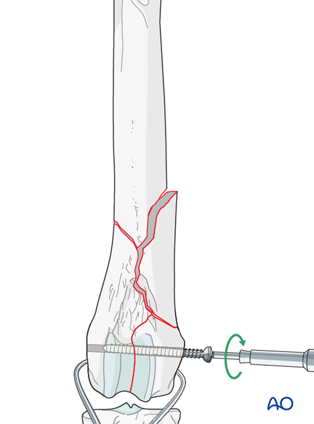 D33_P201_i080 Stabilization is achieved with inserting a lag screw across the condyles perpendicular to the fracture plane
