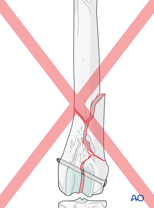 D33_P201_i100 If the screw is not placed perpendicular to the fracture plane, this will result in loss of anatomic reduction of the articular surface