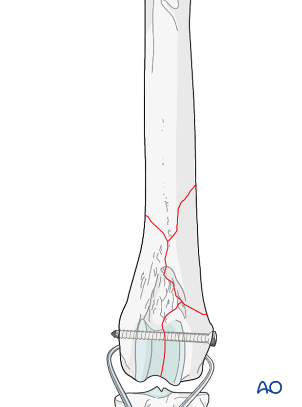 D33_P201_i120 Anatomic reduction and interfragmentary compression is achieved with additional independent lag screws