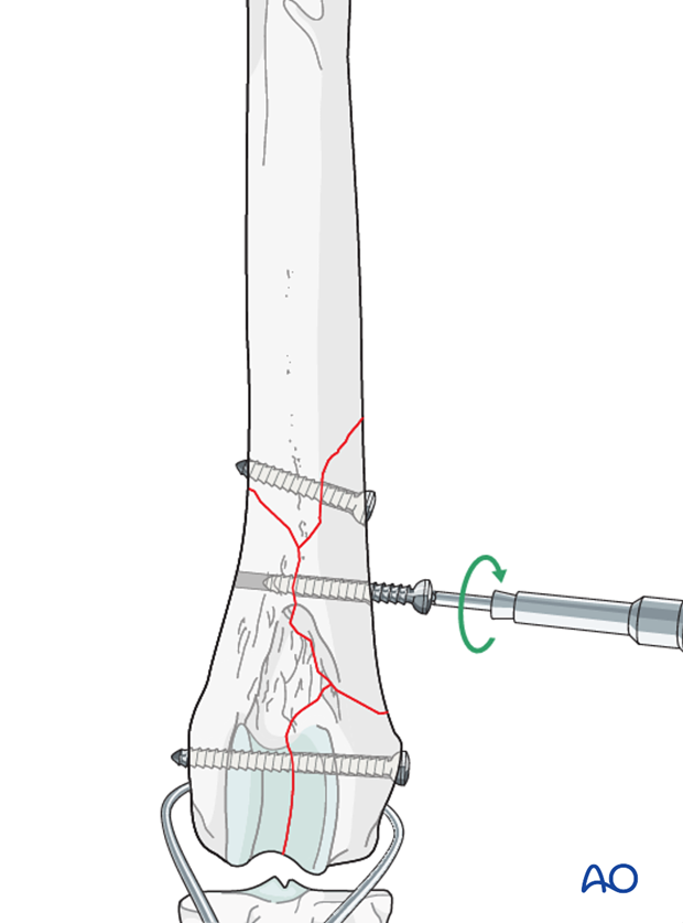 D33_P201_i140 Bone holding forceps are applied to the proximal and distal major fragments for distraction