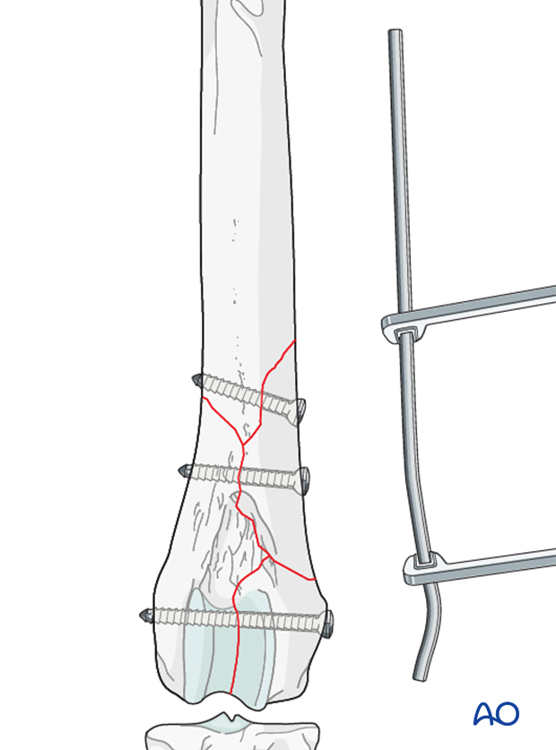 D33_P201_i180 The plate is contoured to the lateral aspect of the distal femur