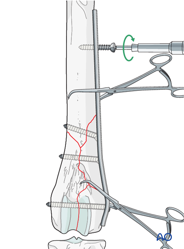 D33_P201_i200 A screw is inserted in the proximal fragment in the neutral position