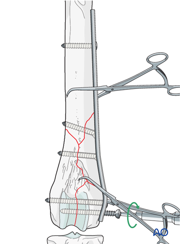 D33_P201_i220 a lag screw may be inserted through the plate to achieve interfragmentary compression