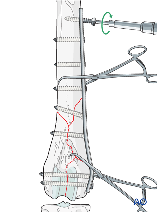 D33_P201_i240 The remaining screw holes are filled