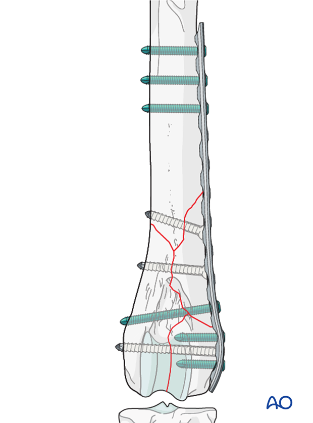 D33_P201_i260 If a locking plate is used, only 2-3 locking bicortical screws are needed per main fragment