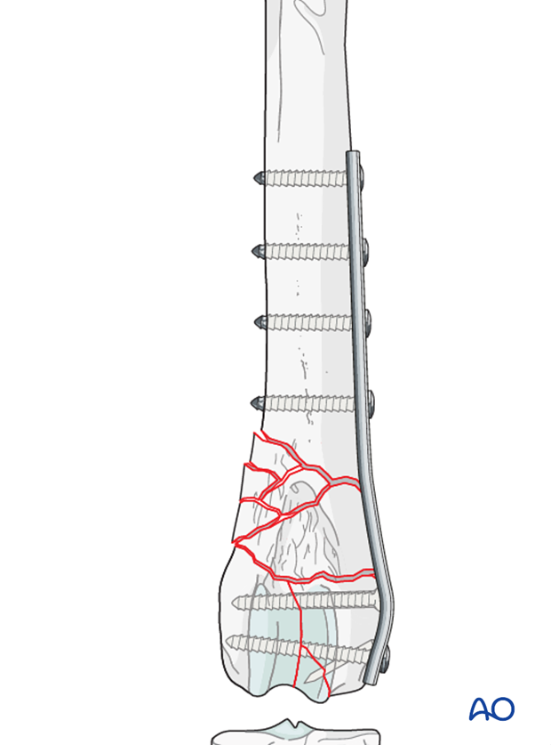 Distal femoral fracture in a dog repaired with transcondylar lag screw and bridging plate